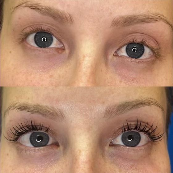 Before & After Dysport treatment for fine lines and wrinkles on the forehead.