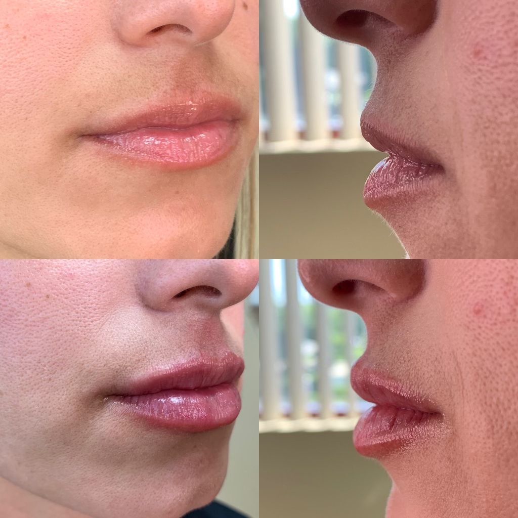 Injectable filler treatment for lip enhancement and wrinkle reduction.