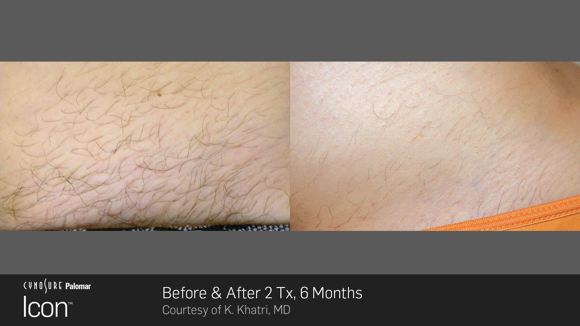 ICON Laser Hair Removal before-and-after results on legs.
