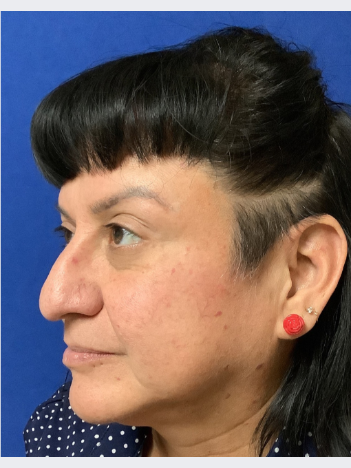 After IPL for redness