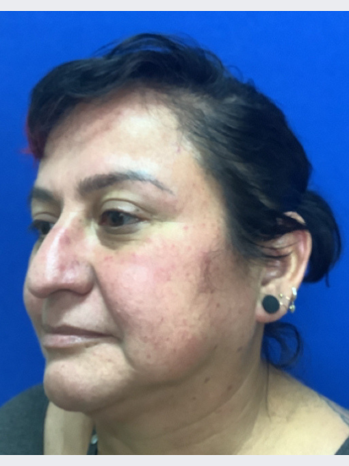 Before IPL for redness