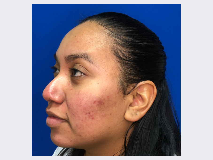 After Opus treatment with smoother, scar-free skin.