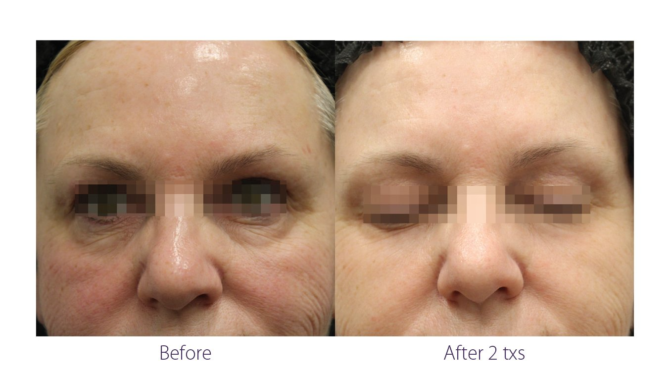 Opus Plasma before-and-after results showing improved skin texture.