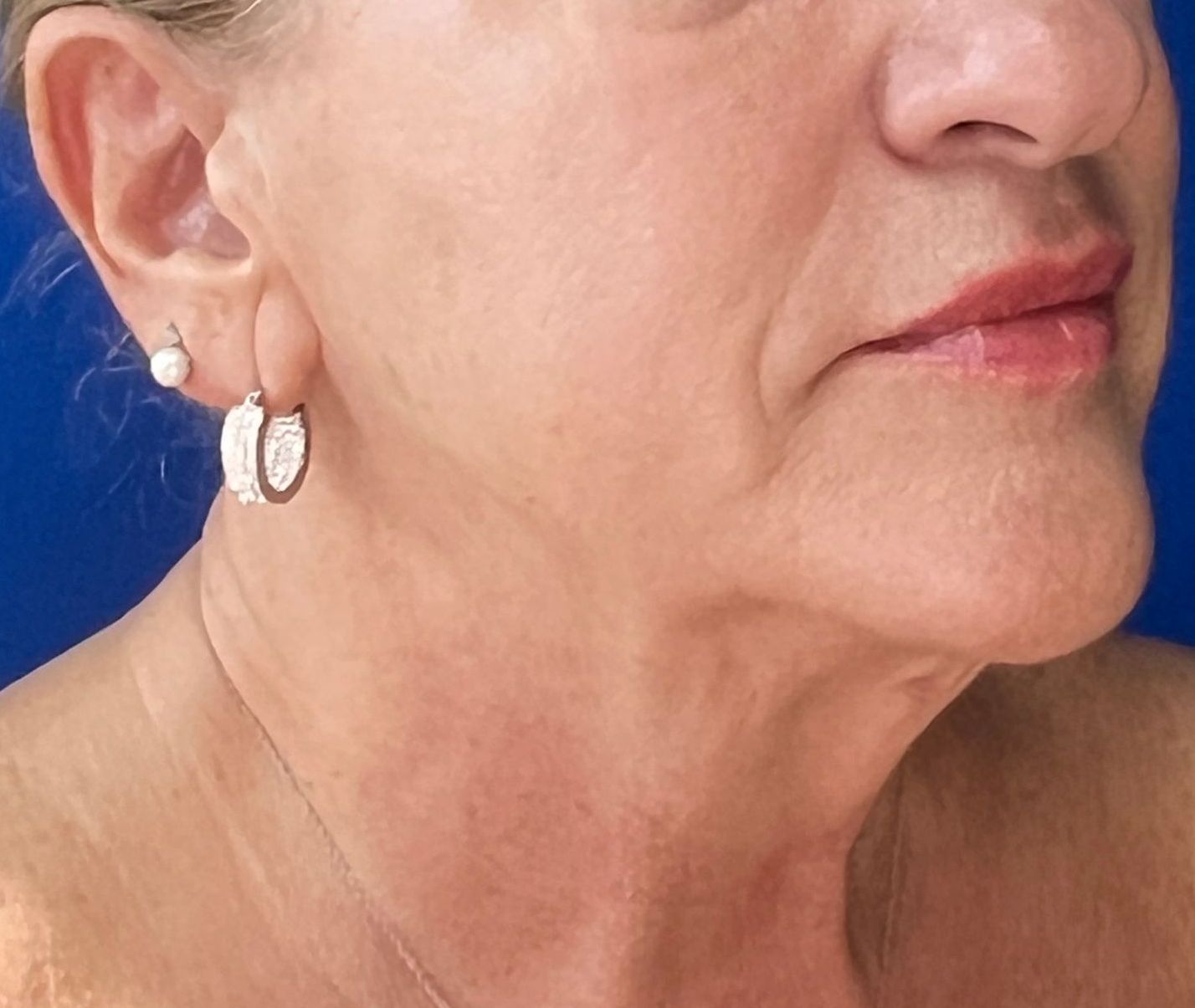 After Potenza microneedling treatment with firmer, tightened skin