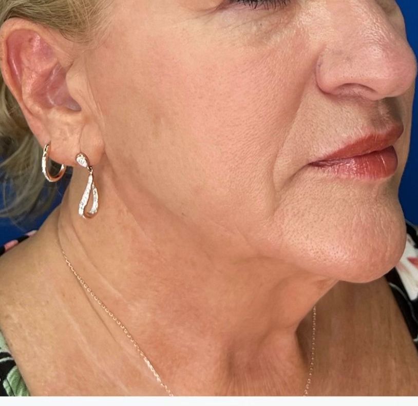 Before Potenza microneedling for tightening skin