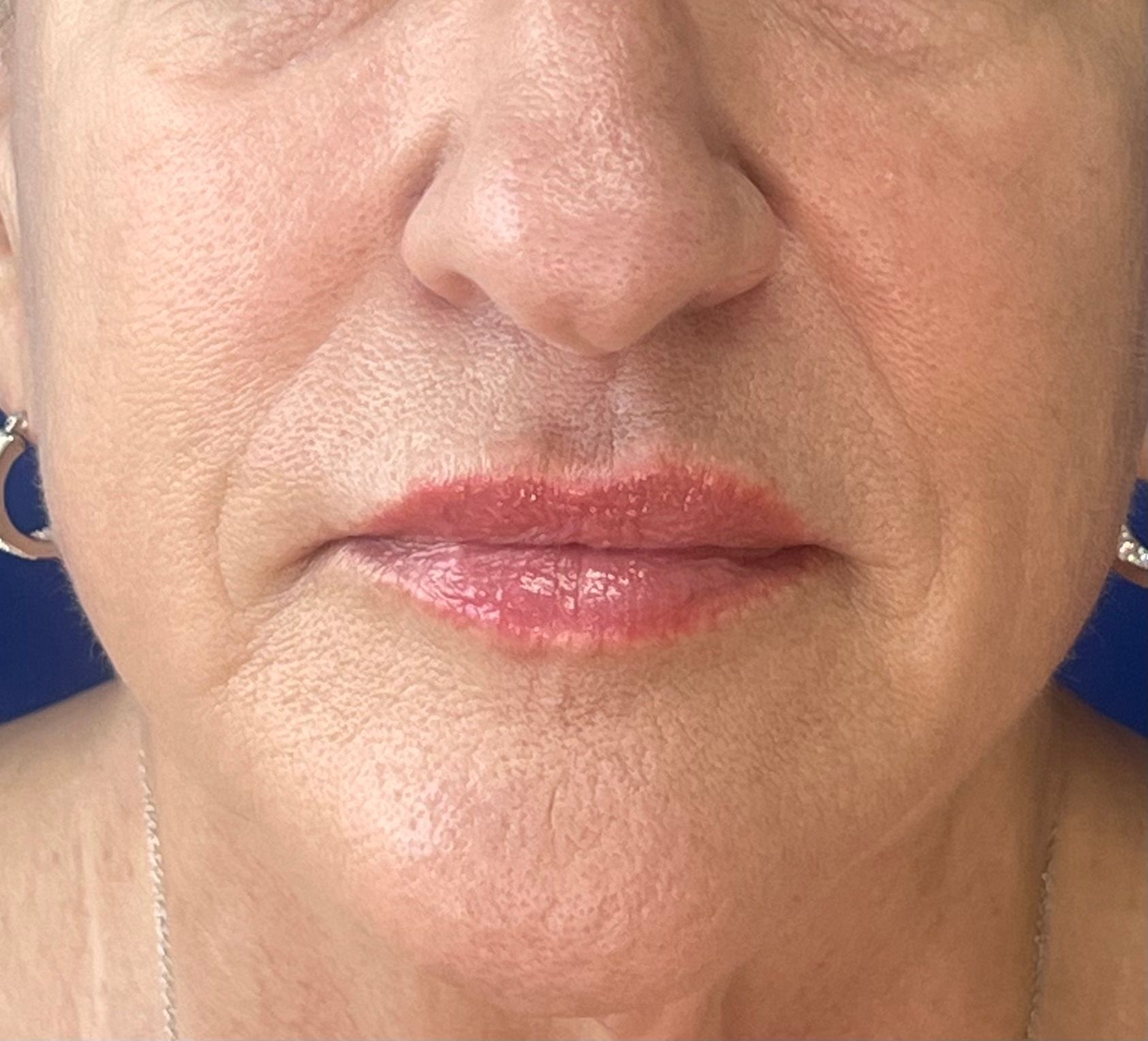 After Potenza microneedling treatment for wrinkle reduction