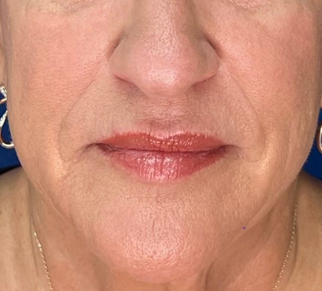 Before Potenza microneedling treatment for wrinkle reduction