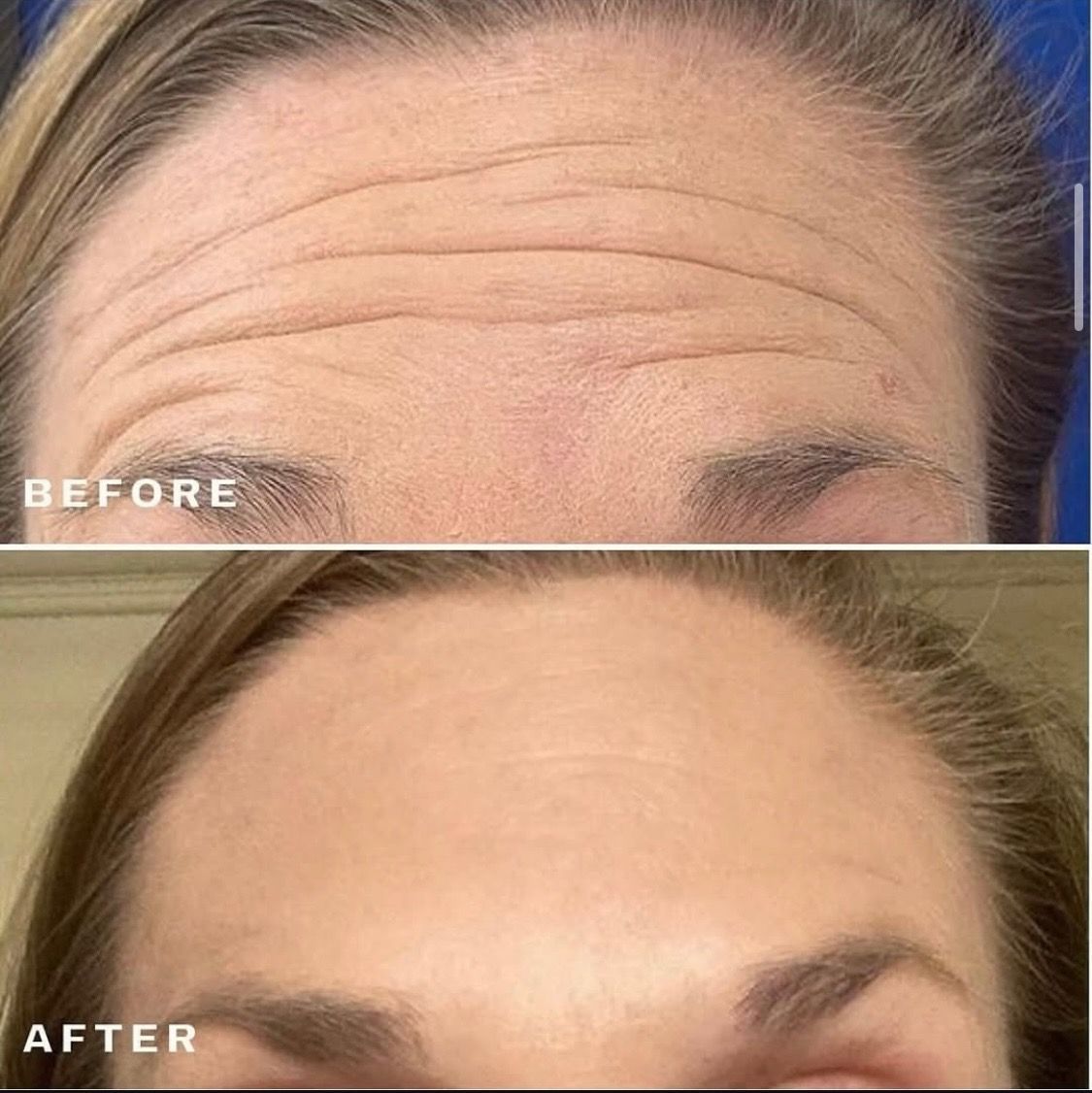 Before & After Dysport treatment for fine lines and wrinkles on the forehead.
