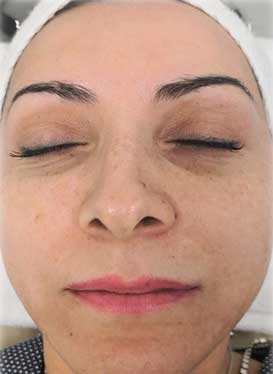 AquaFirme after-treatment results showcasing radiant, hydrated skin.