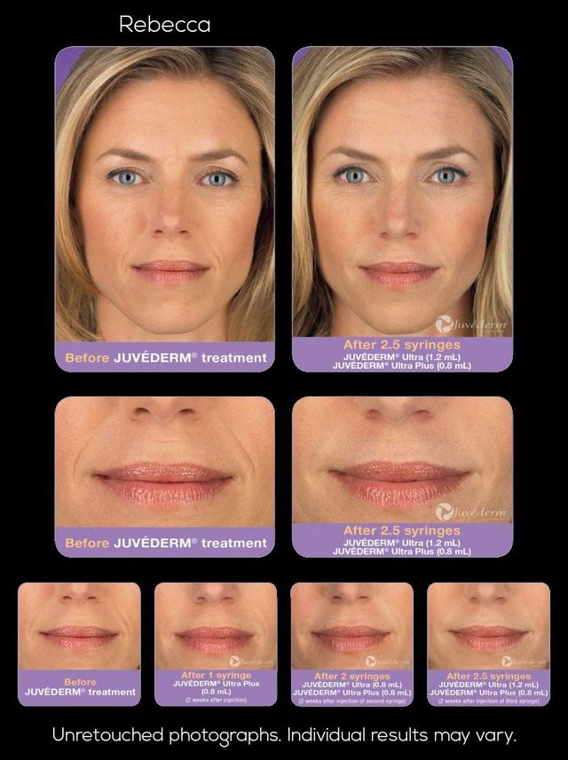 Fascination About What Is Juvederm Made Of? - Plastic Surgeon Dr. Jon Ver Halen thumbnail