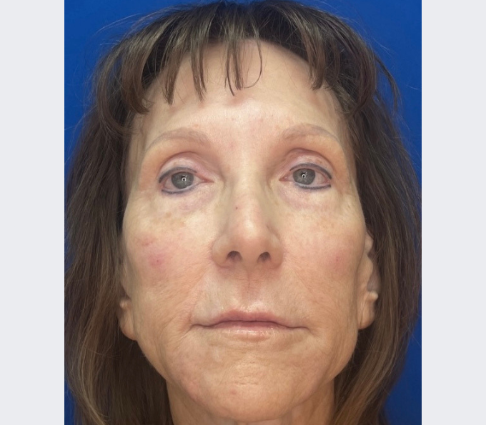 After injectable lip filler