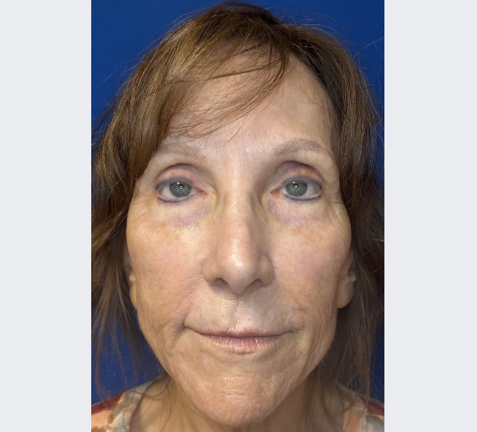 Before injectable lip filler