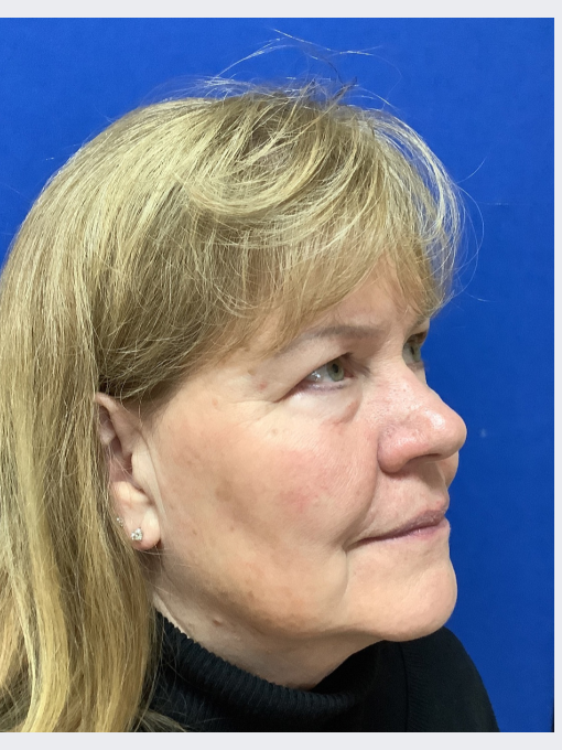 After IPL for Brown Spots 