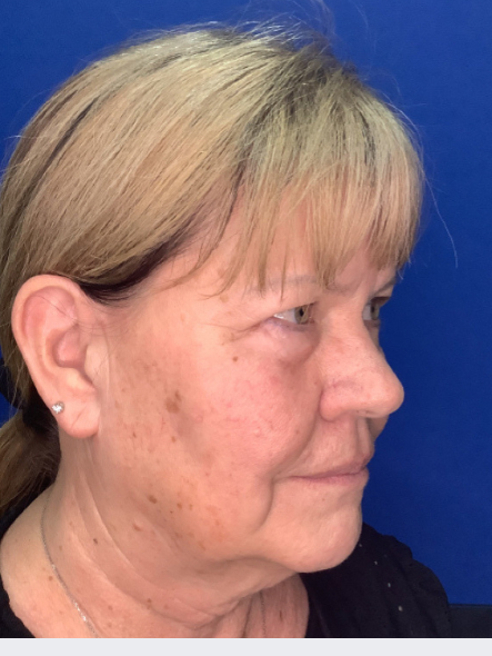 Before IPL for Brown Spots 