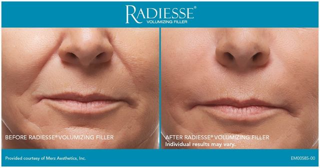 Some Of Which Injectable Is Best For Me? Comparing Juvederm And ... thumbnail