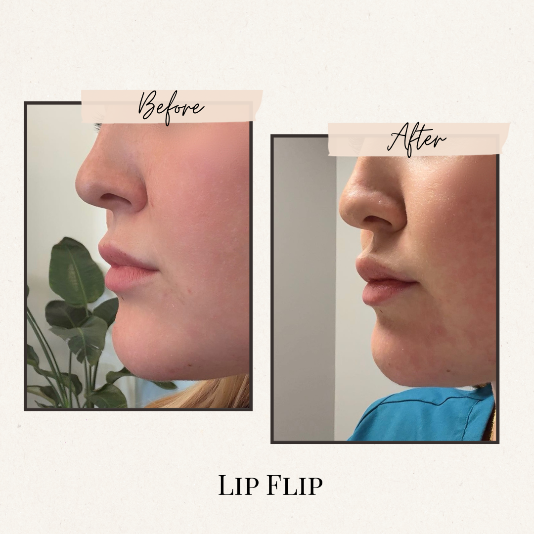 Before and after view of a woman's lips, showing a 