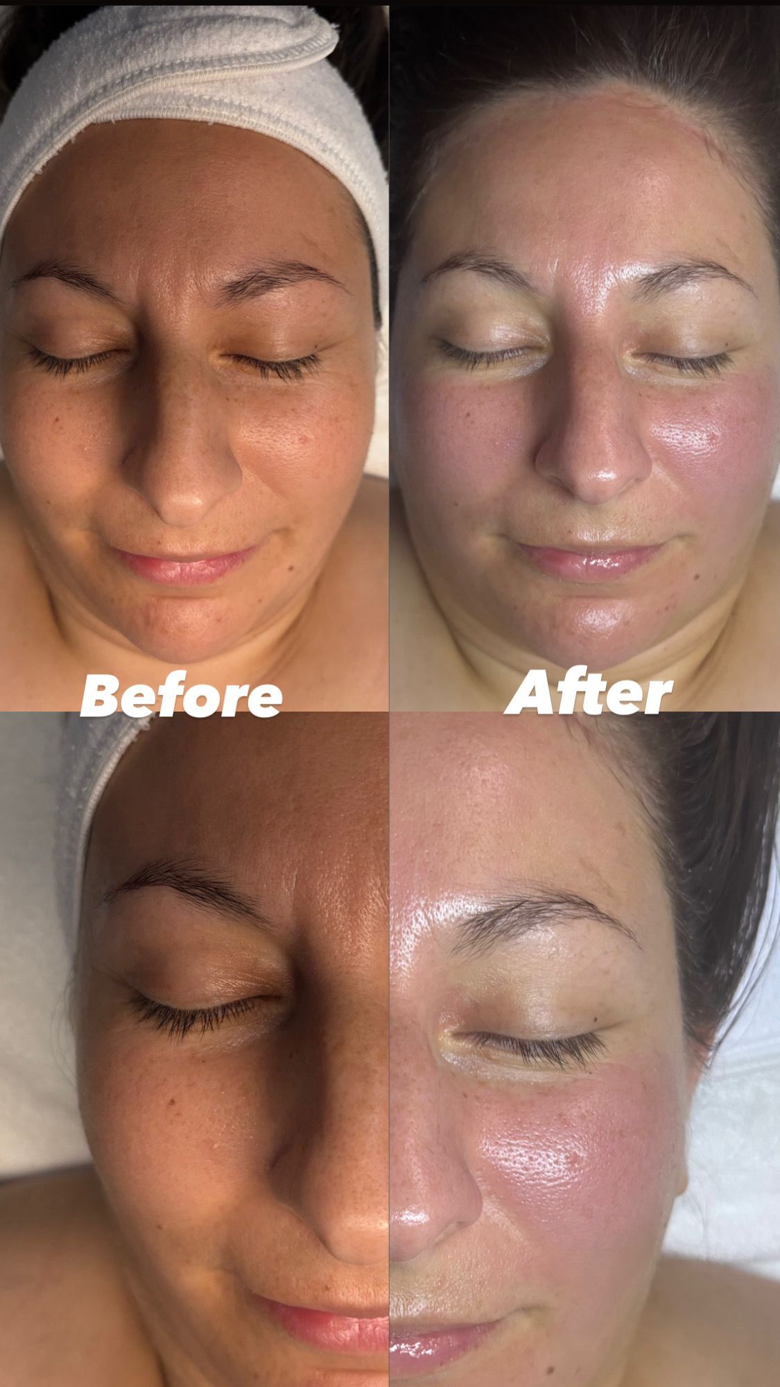 Two facial shots: before & after treatment, showing reduction in redness and blemishes, and smoother skin.
