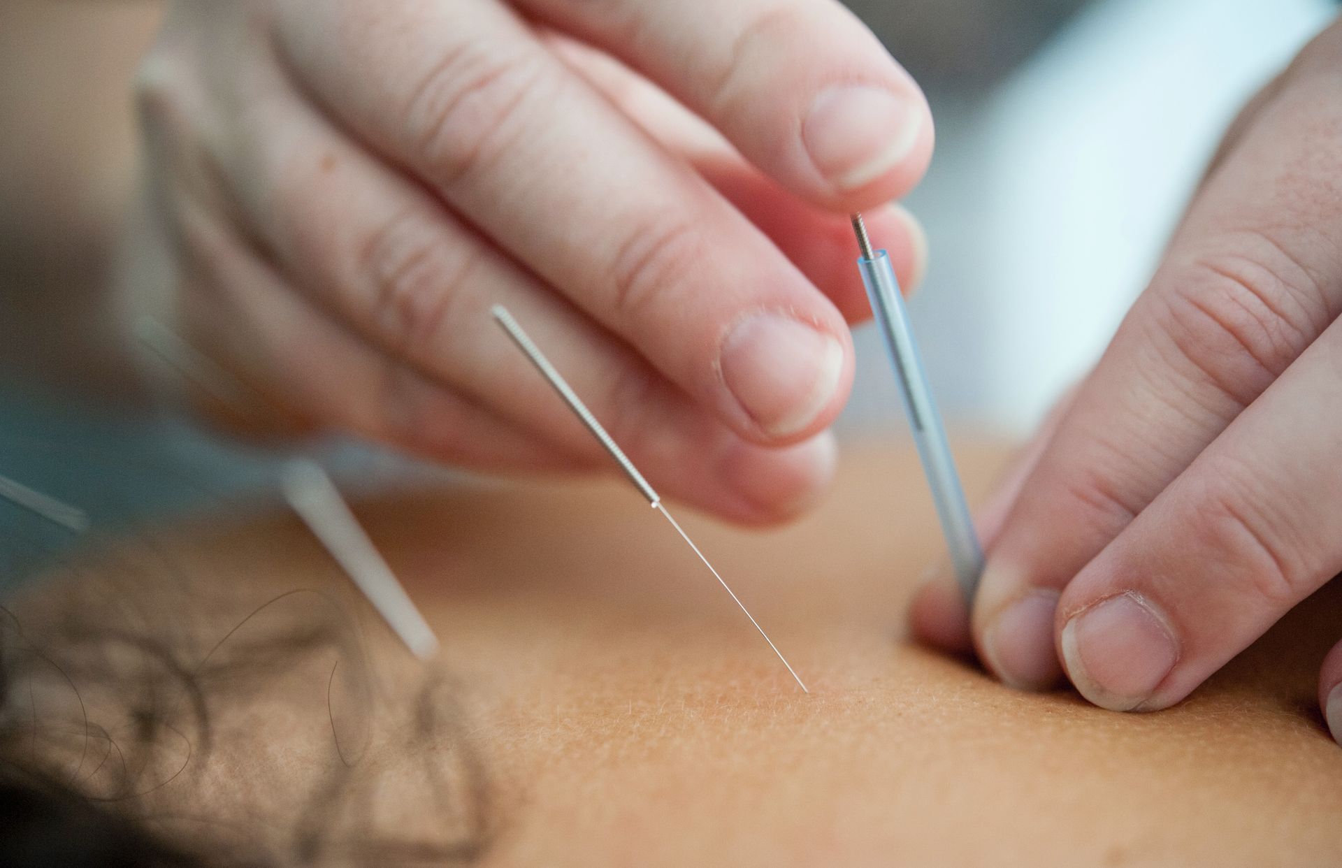 Hands inserting acupuncture needles into skin during a treatment session