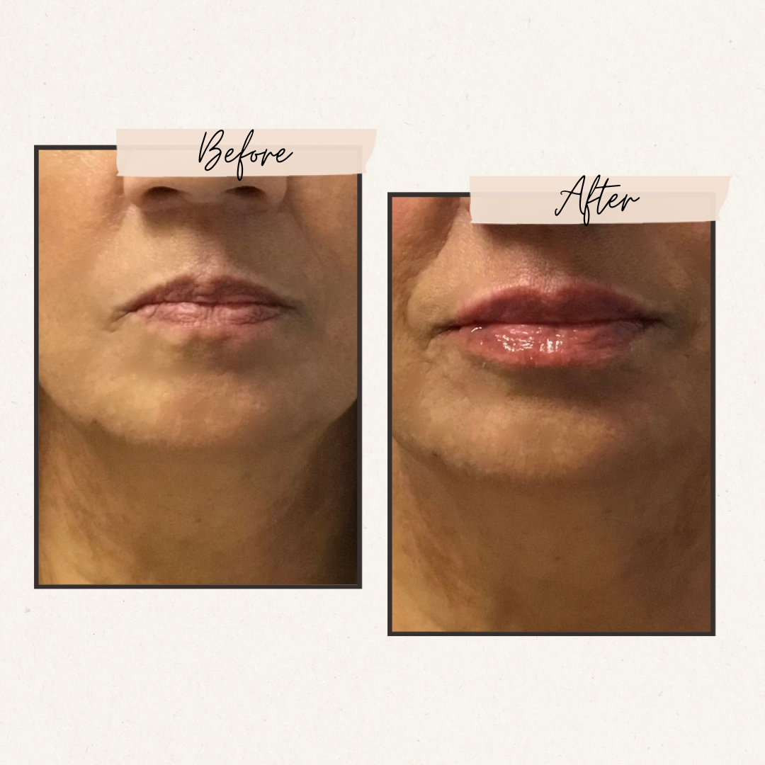 Side-by-side comparison of lips before and after lip filler treatment; lips appear fuller in the 