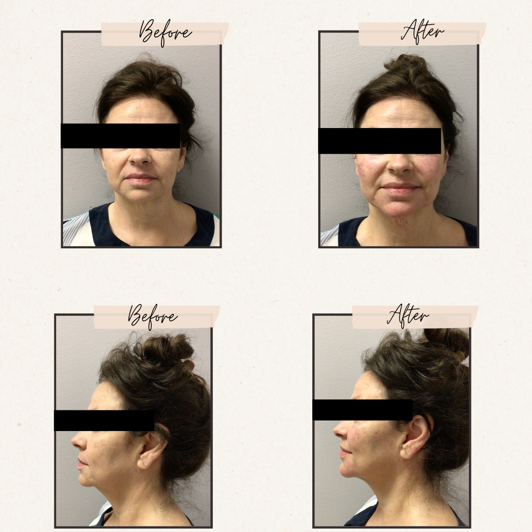 Side-by-side comparison of a person's face before and after a cosmetic procedure, frontal and side views.