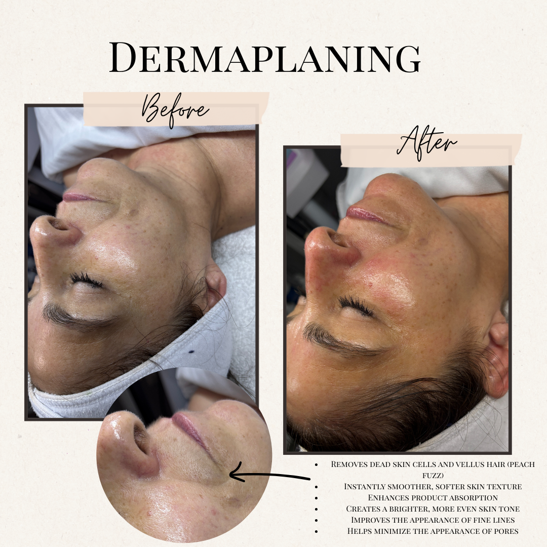 Before and after dermaplaning results on a face, showing smoother skin.