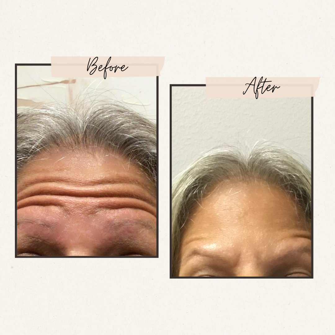 Before and after comparison of forehead wrinkles, smoothed after treatment.