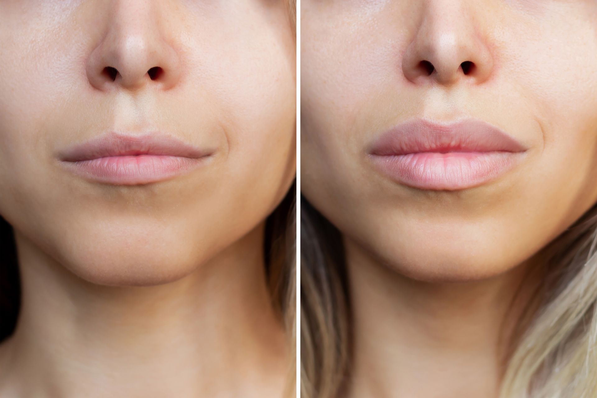 A before and after photo of a woman lip filler treatment.