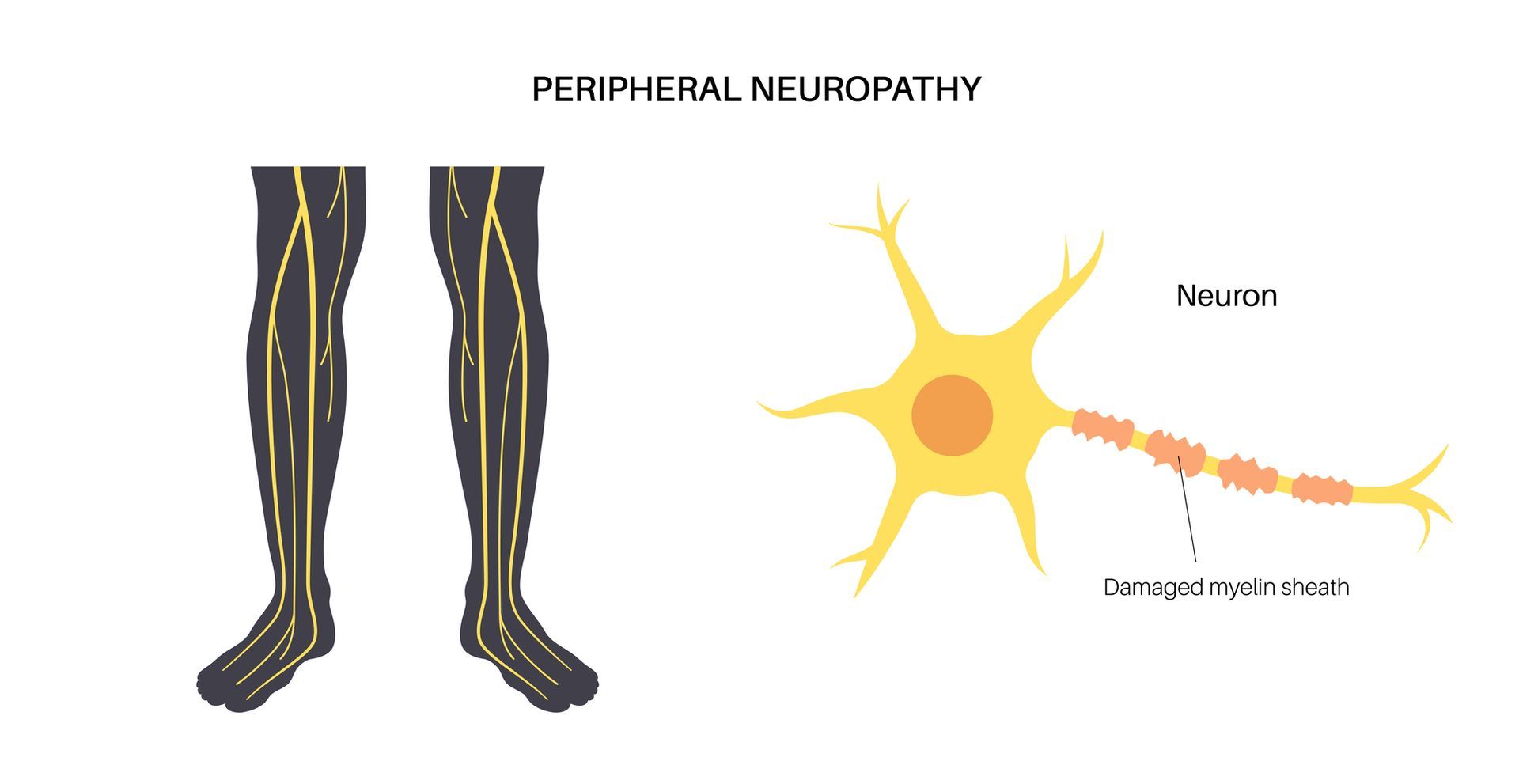 A diagram of a person's legs and a damaged neuron depicting peripheral neuropathy