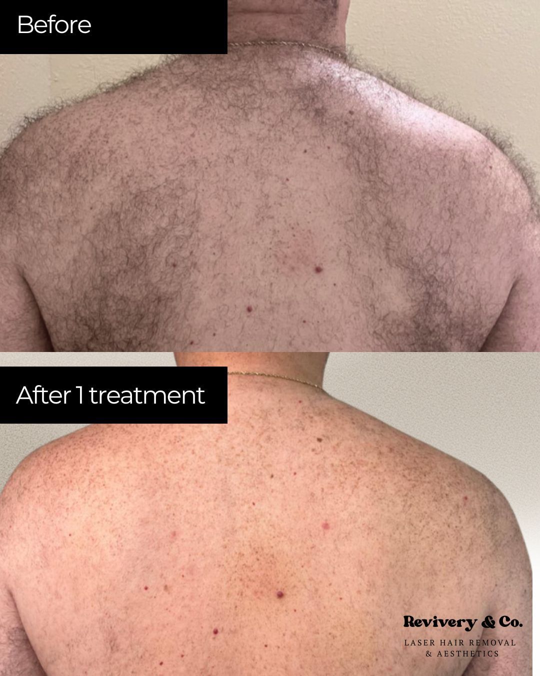 laser hair removal cochrane