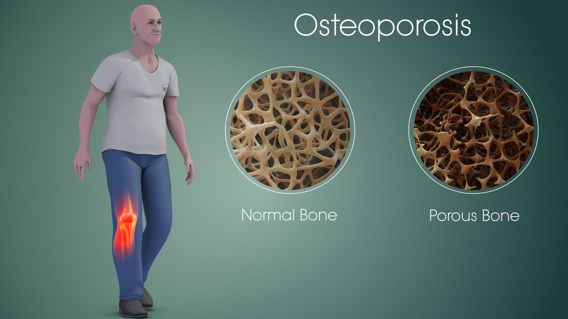 Osteoporosis Help with No Drugs
