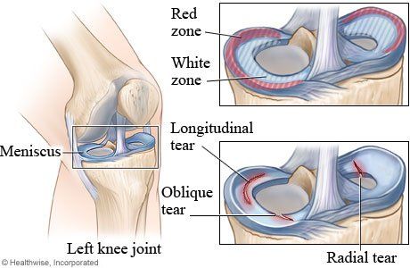 Knee Pain Treatment