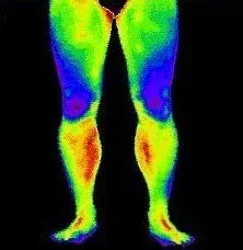 Thermal image of legs, showing cooler blue areas and warmer red/yellow regions.