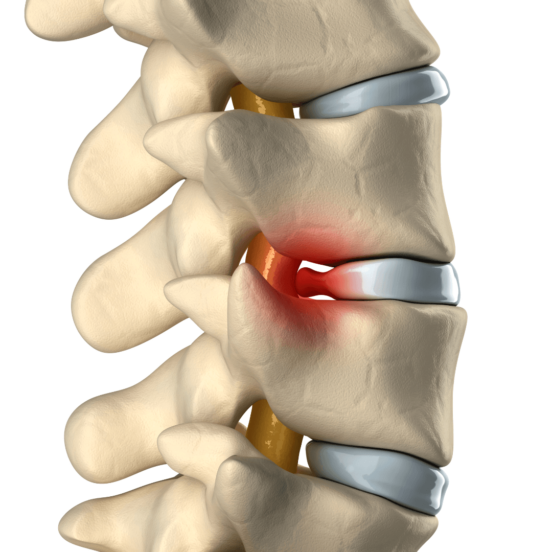 Tratamento da hérnia de disco sem cirurgia