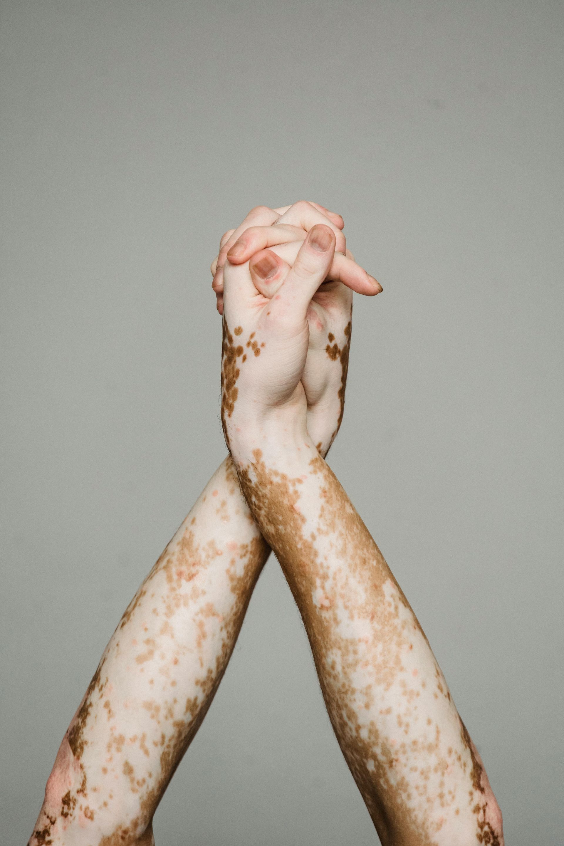 vitiligo treatment options in San Francisco