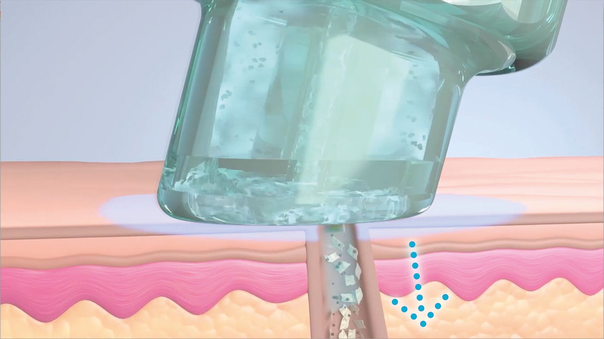 Medizinisches Gerät trägt Gel auf Haut auf, Verfahren zur Einschleusung in Haarfollikel, Hydrafacial-Behandlung demonstriert.