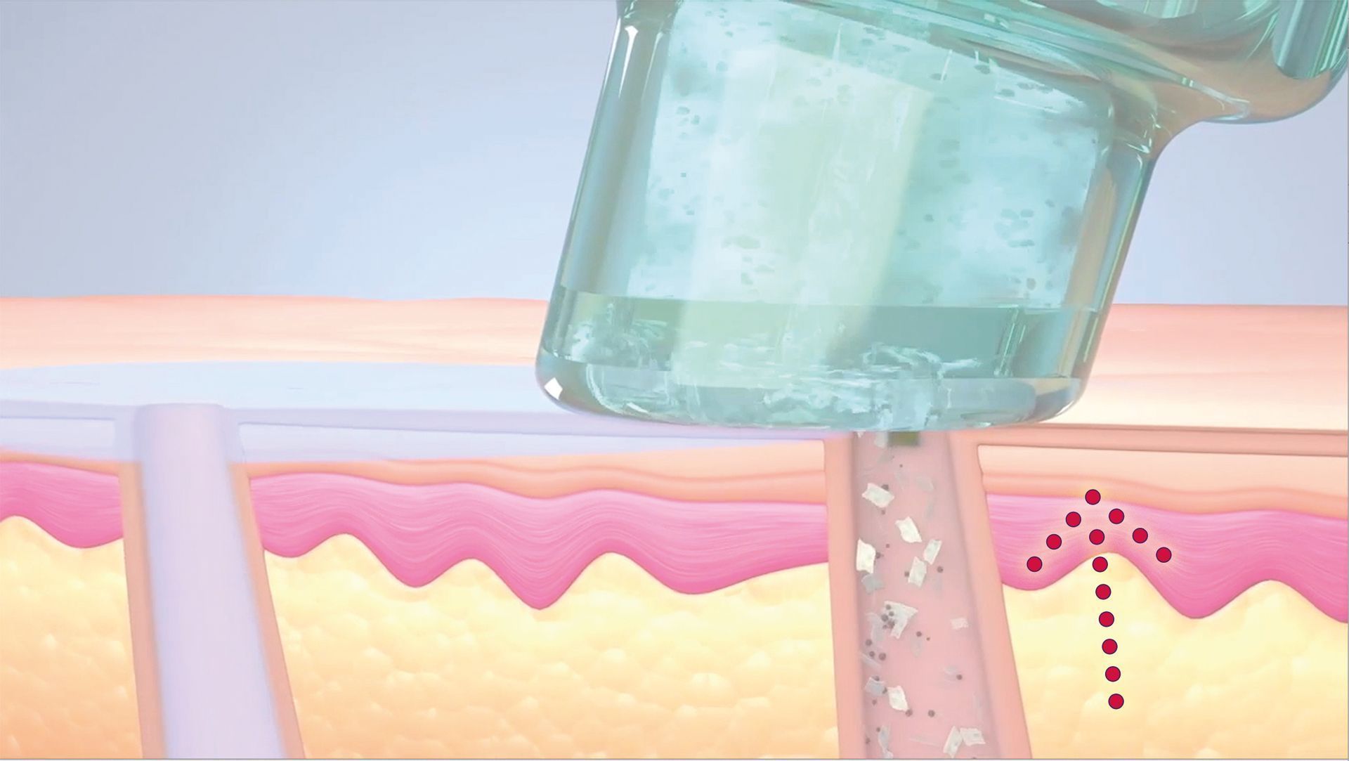 Hellblauer Kosmetikapplikator auf Haut, zieht Material aus Pore, rote Punkte nach oben, Hydrafacial-Tiefenreinigungsprozess.