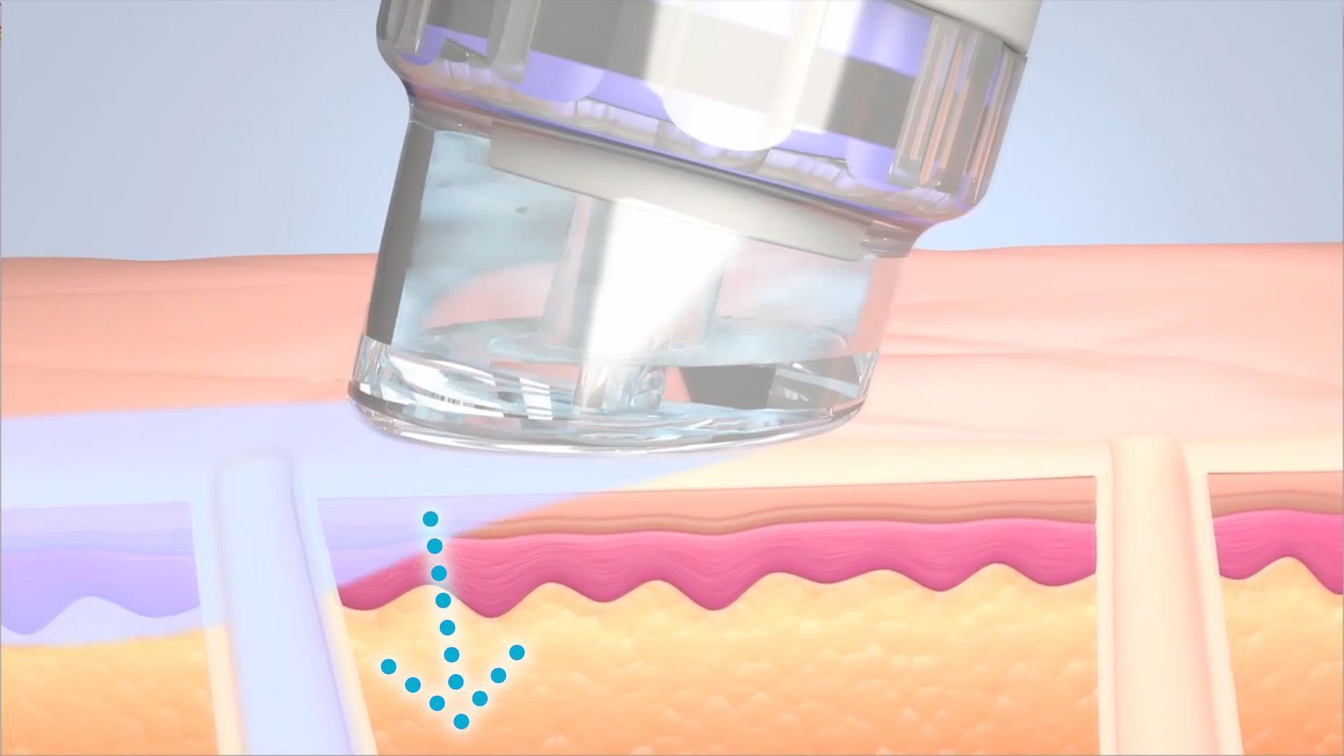 Kosmetikgerät zur Hautbehandlung in Querschnittsdiagramm, Pfeile nach unten zeigen Wirkungsweise der Anwendung, Hydrafacial.