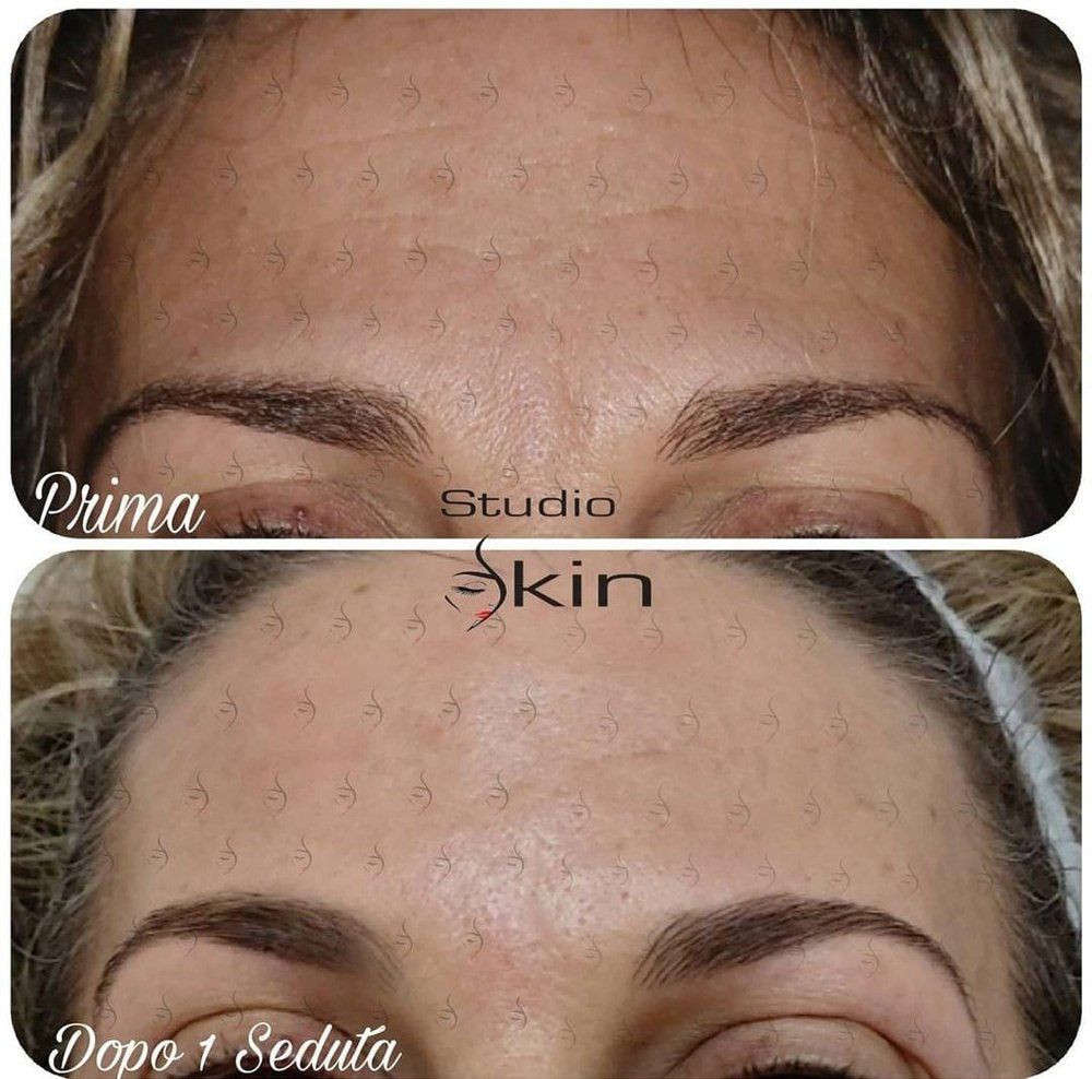 Trattamento con Teslamed prima e dopo