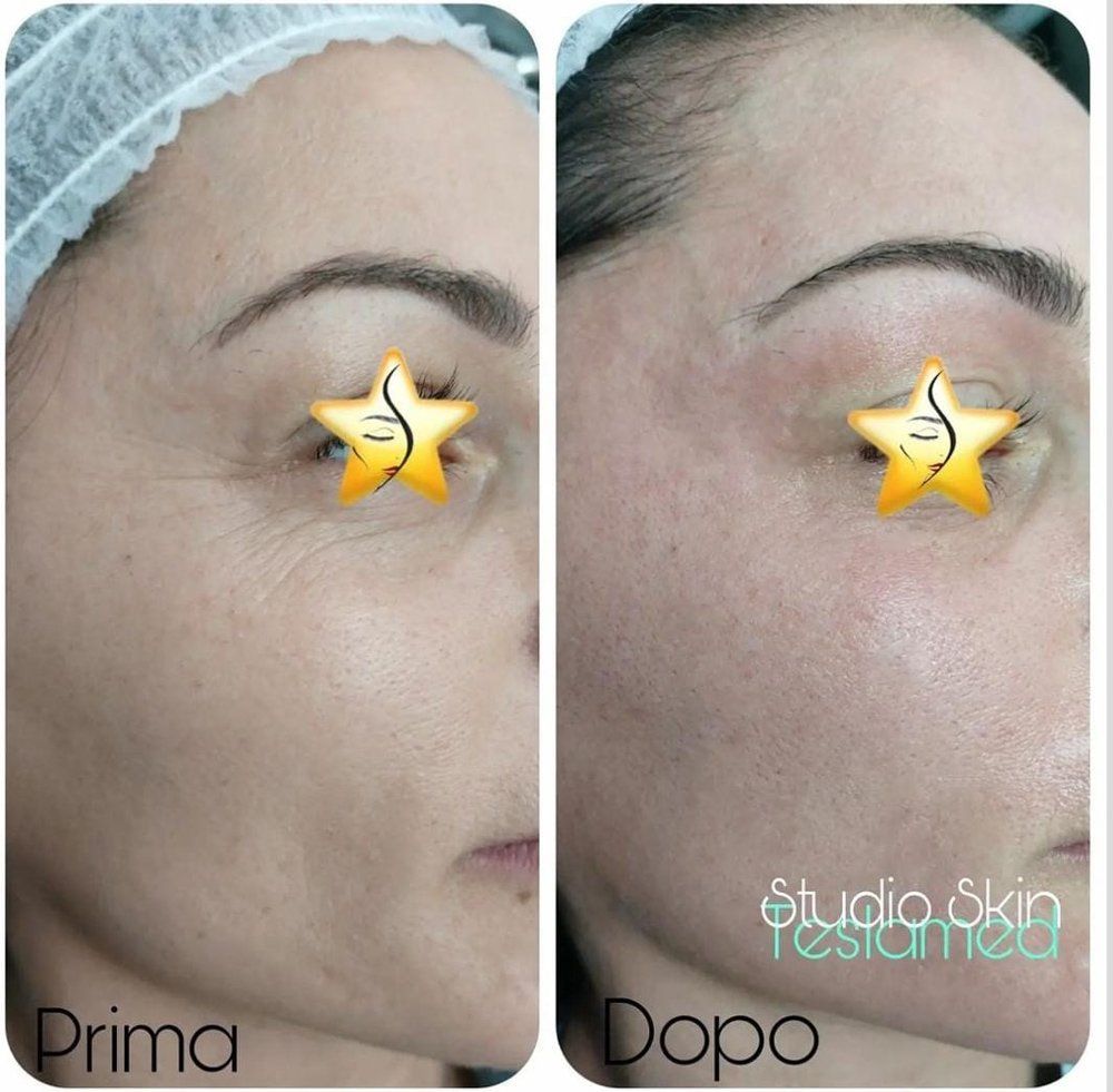 Teslamed per rughe del viso