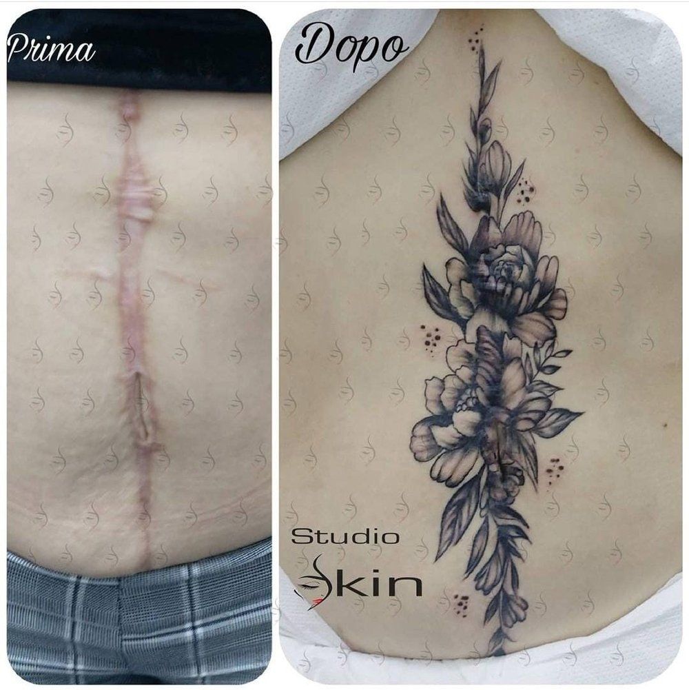 Tatuaggio per cicatrice