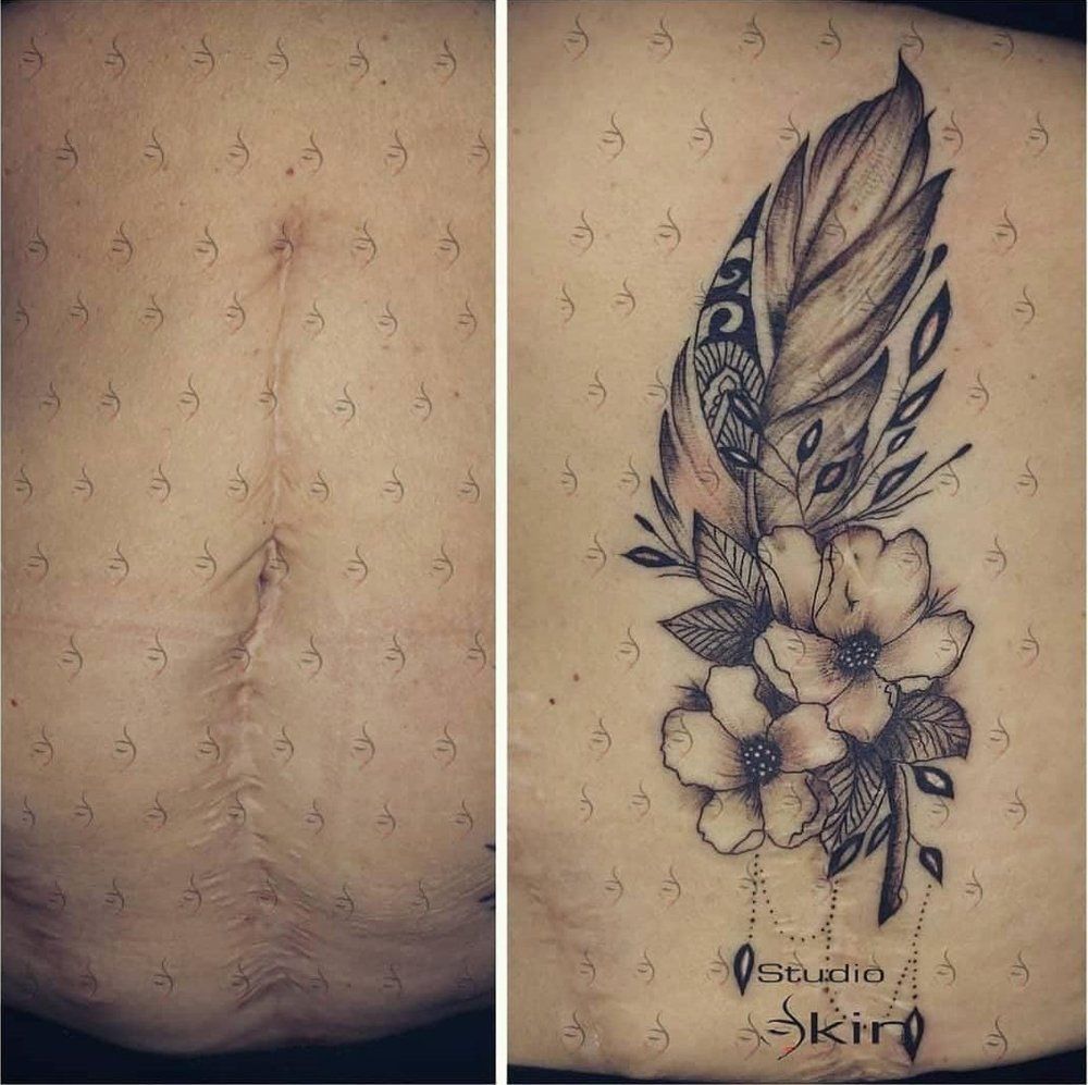 Cicatrice coperta da tatuaggio