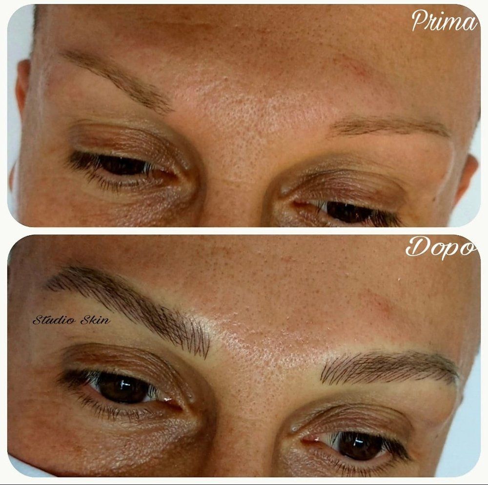 Dermopigmentazione oncologica