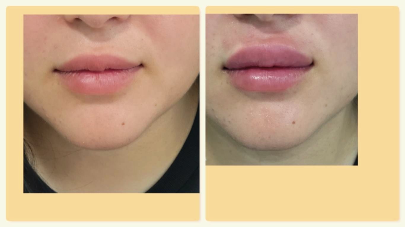 riduzione delle rughe del viso