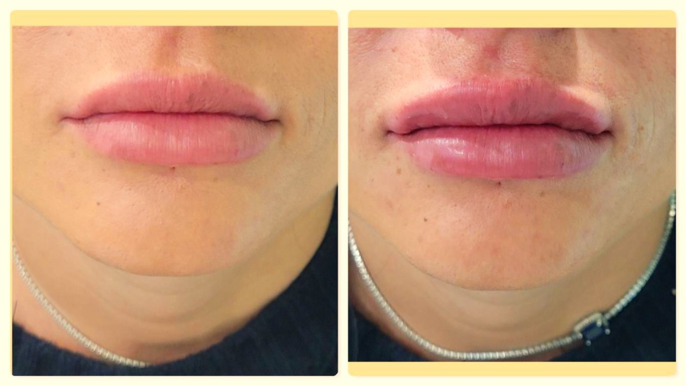 trattamento inestetismi delle labbra