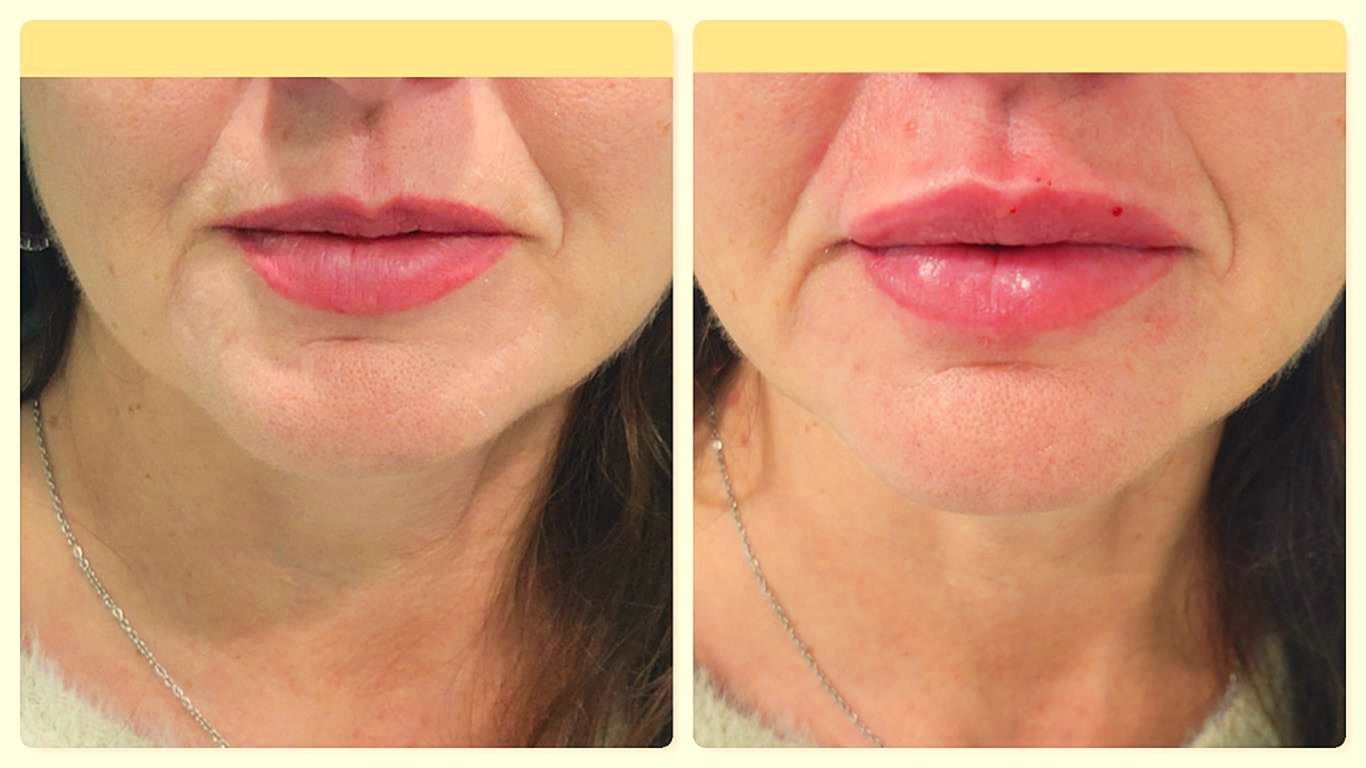 prima e dopo cura estetica delle rughe