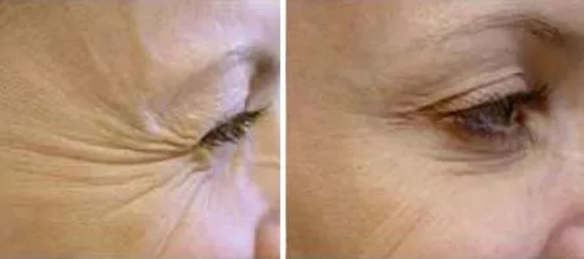 riduzione delle rughe nella zona perioculare