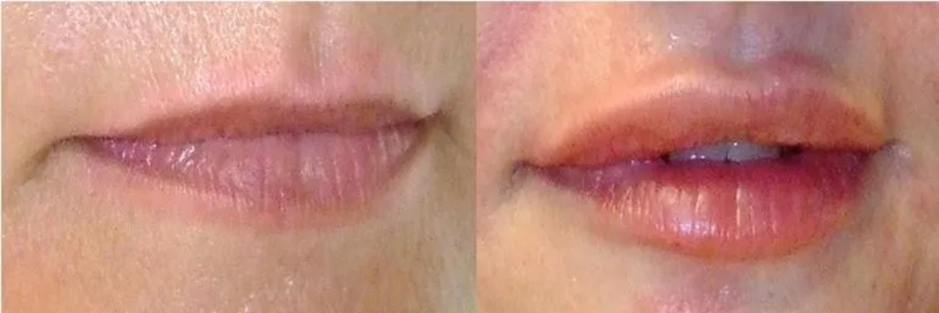 prima e dopo trattamento alle labbra