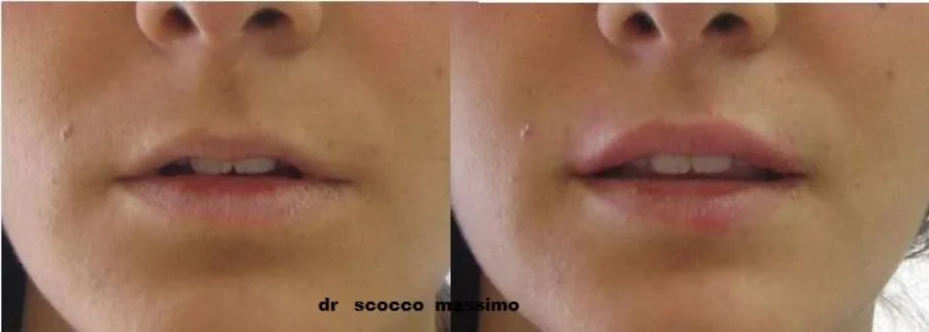 trattamento inestetismi delle labbra