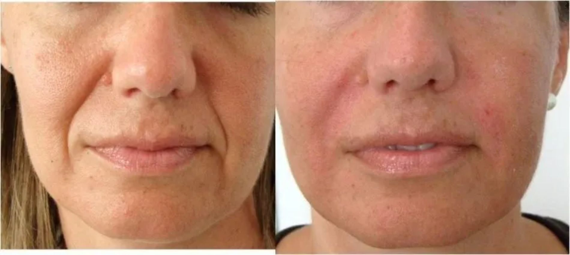 notevole riduzione delle rughe del viso