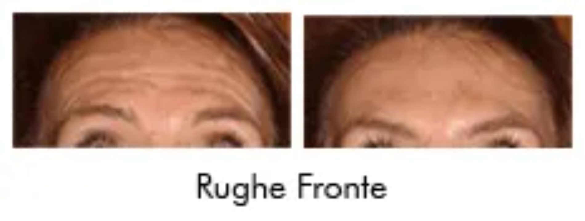 riduzione delle rughe della fronte